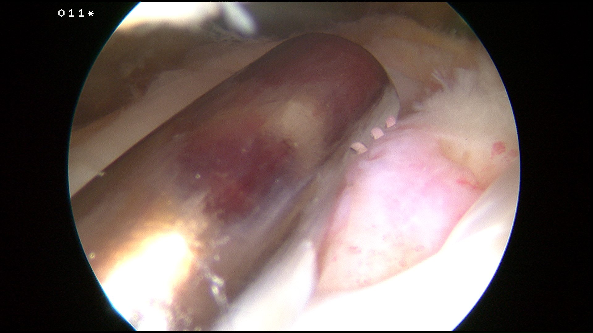 Arthroscopic Cuff Prepare Insertion